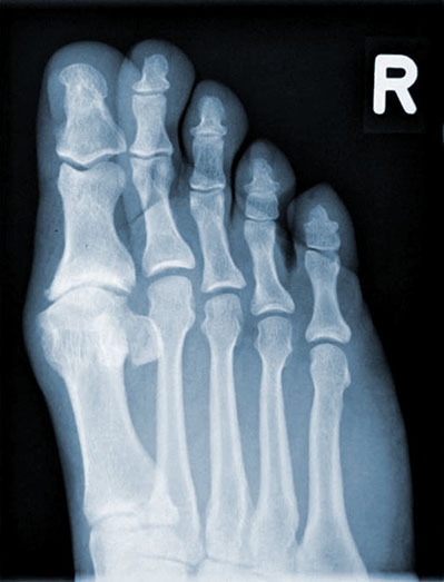 Rigid Big Toe (Hallux Rigidus) | ORTHO - Praxis am Goetheplatz